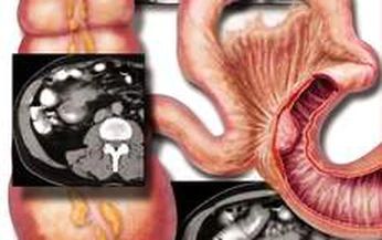 U carcinoid - một dạng ung thư đặc biệt